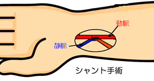 図：シャント手術